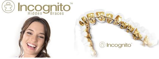 Incognito Hidden Braces Work Incognito Hidden Braces Work