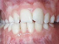 Cross bite Cross bite