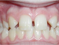Missing teeth Missing teeth