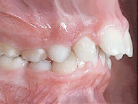 Protruded teeth Protruded teeth