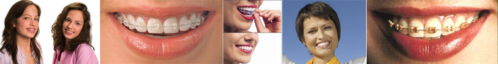 Types of braces Types of braces