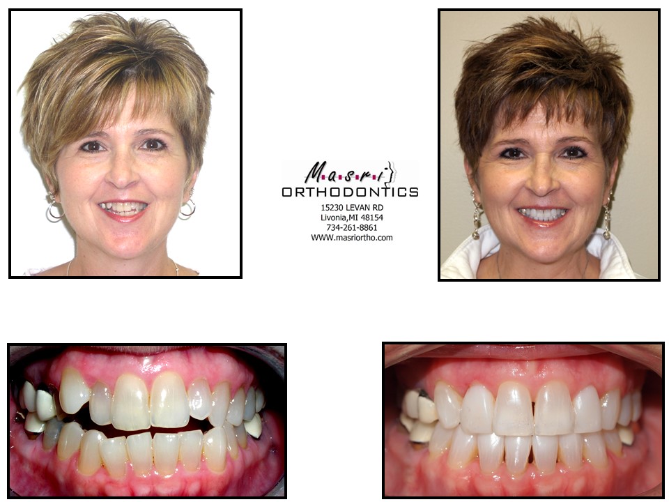 Before & After Masri Orthodontics