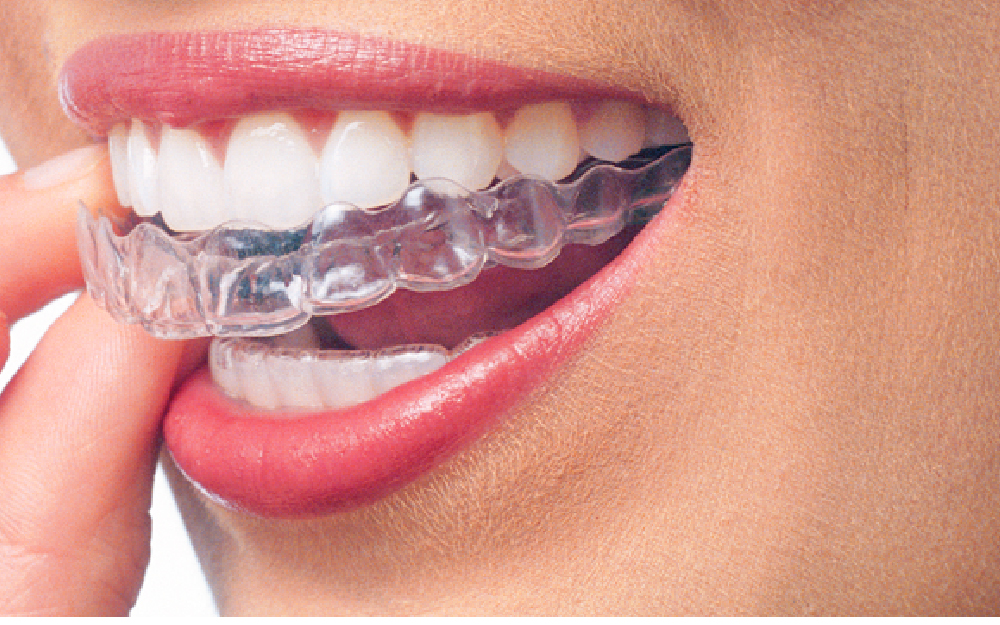 13 Invisalign Questions Answered By Michigan's Top Invisalign