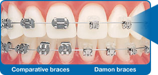 What are Self-Ligating Braces?