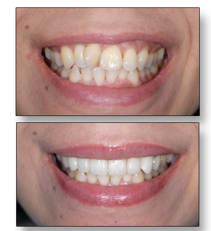 Instant orthodontics Instant orthodontics