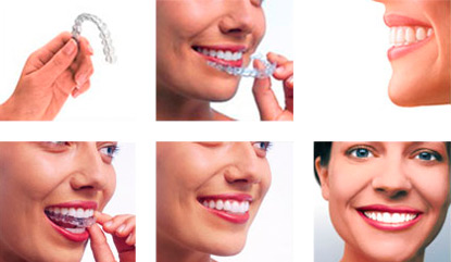 Invisalign For Teenagers And Adults
