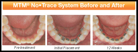 MTM No-Trace System before and after