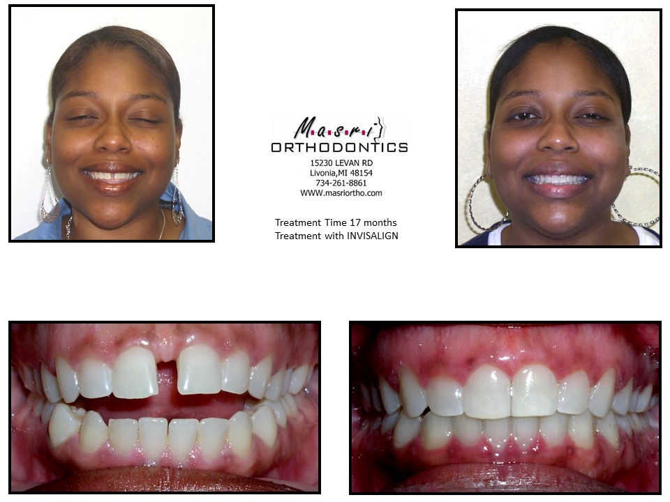 Braces Before And After Open Bite