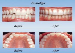 How-Long-Does-Invisalign-Take