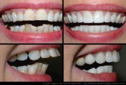 Main-Causes-of-Crooked-Teeth