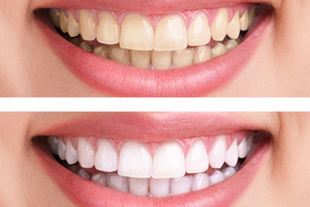 Teeth Whitening by Masri Orthodontics Livonia