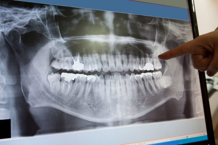 Digital Dental X Ray Importance
