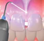 Laser-Use-In-Dentistry1-250x166