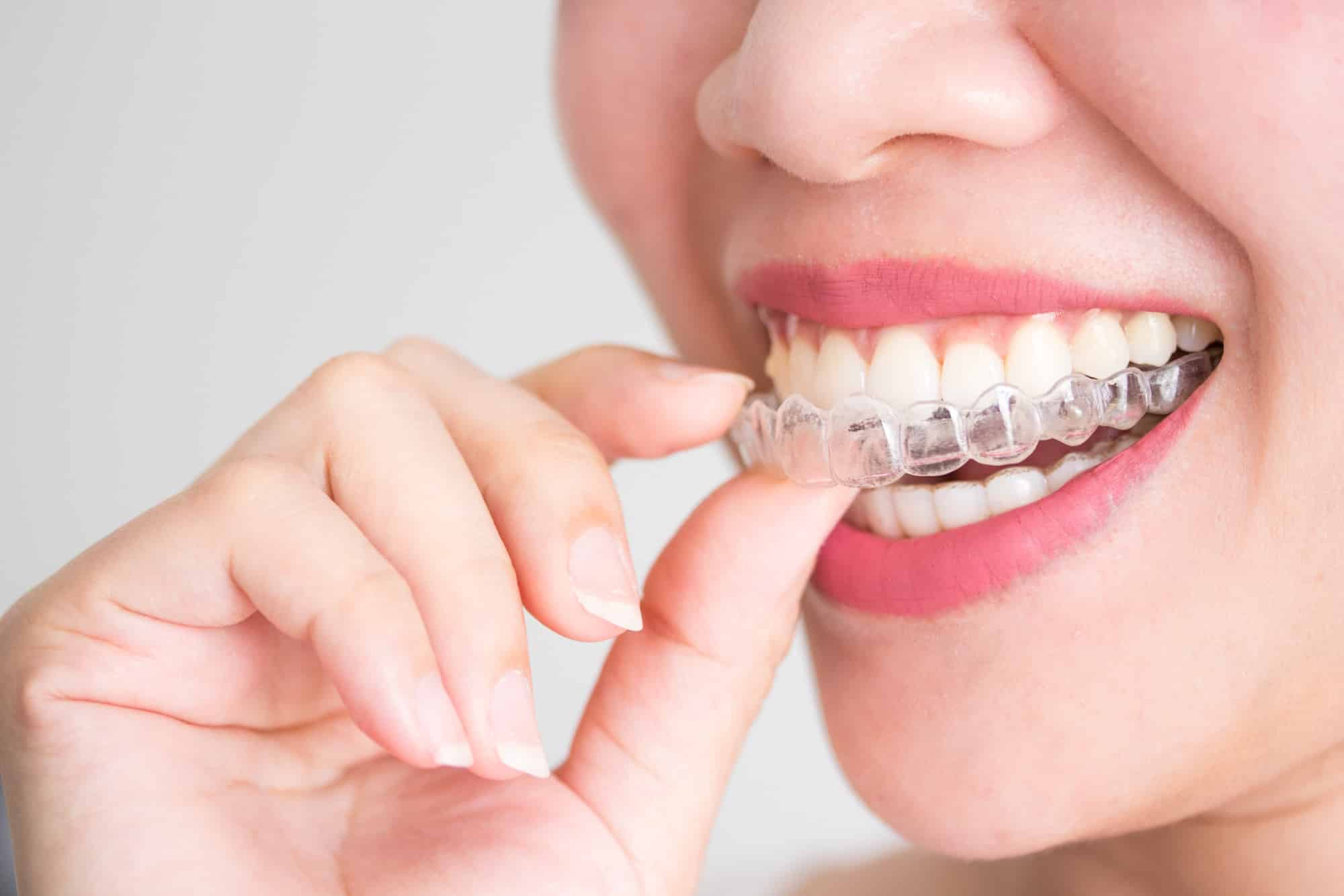 What to Expect when you receive braces? Masri Orthodontics