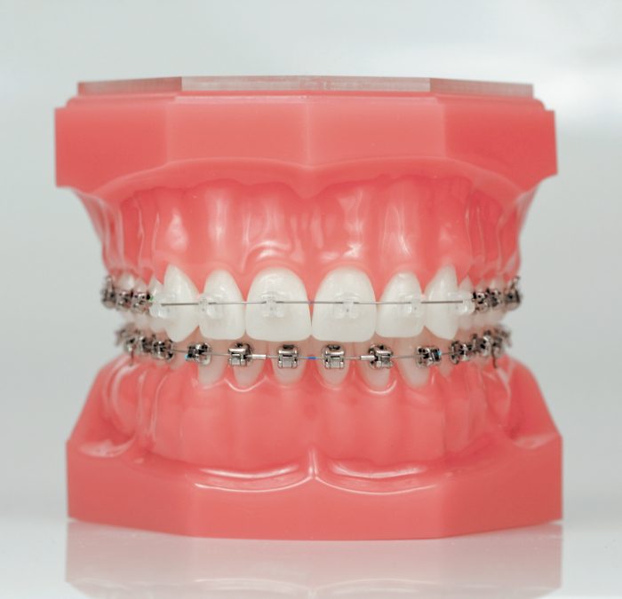 clear braces lower metal masri orthodontics